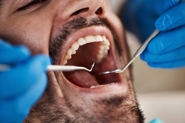 Best Emergency Dentist for Lost Fillings or Crowns in Wye, MT